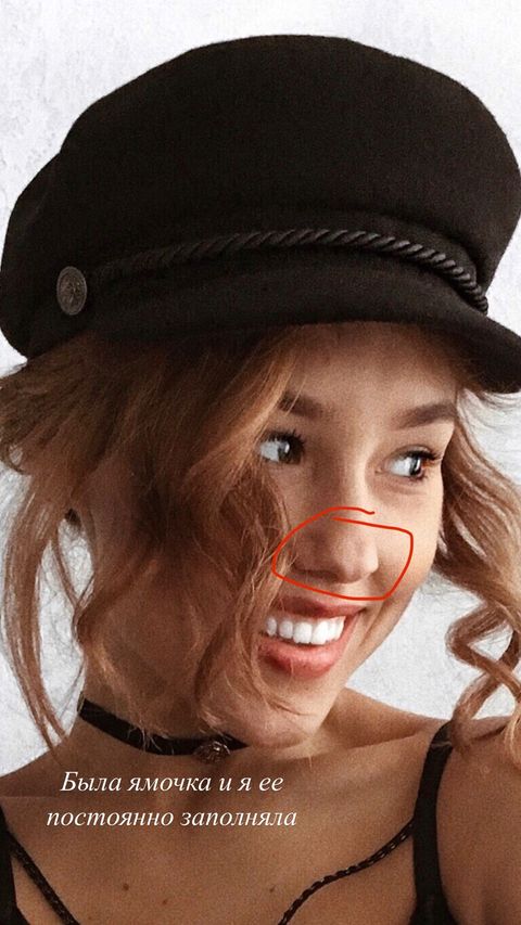 Прокинулася з оновленим носом: Даша Квіткова показала обличчя після пластики