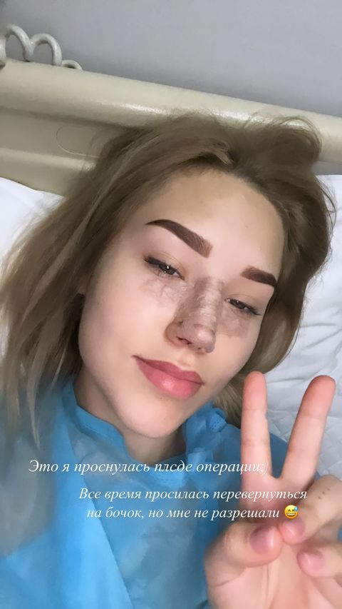 Прокинулася з оновленим носом: Даша Квіткова показала обличчя після пластики