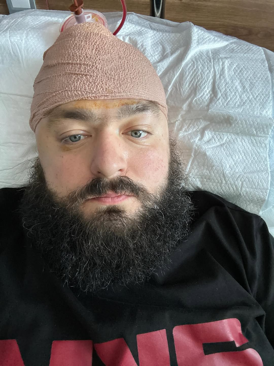 Веня из ВКВ перенес новую операцию: &quot;Теперь 35% моей головы - это сплав титана&quot; (фото)