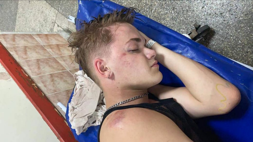 Танцюрист Дорофєєвої вперше про наслідки побиття працівником УДО: &quot;50 шурупів у голові&quot;