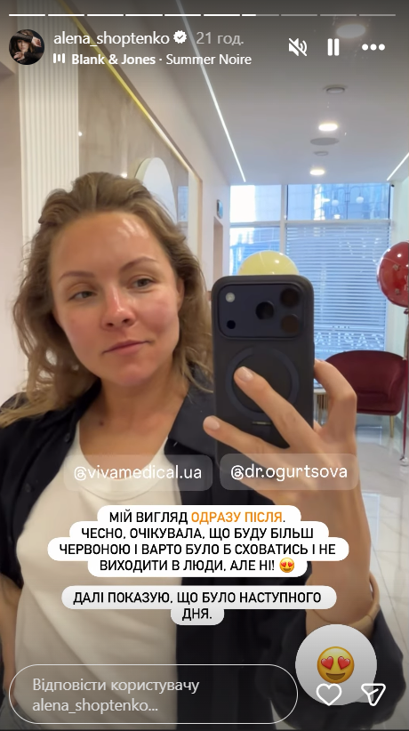 "Решилась": Елена Шоптенко показала результат первой за 38 лет косметологической процедуры